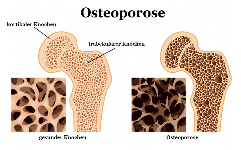 osteoporose knochen